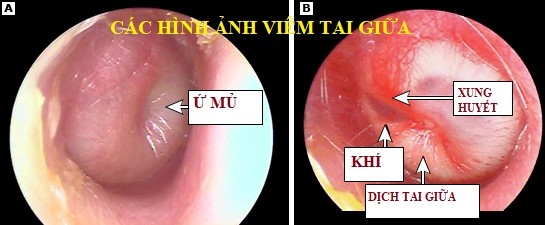 Trẻ bị viêm tai giữa- chăm sóc như thế nào?